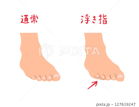 浮き指と通常の足の形の主線なしシンプルイラストセット 浮き指と通常の足の形の主線なしシンプルイラストセット 127619247