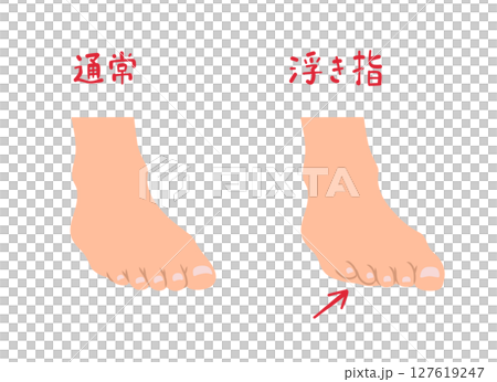 浮き指と通常の足の形の主線なしシンプルイラストセット 浮き指と通常の足の形の主線なしシンプルイラストセット 127619247