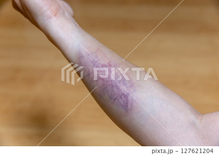 右腕の打撲の青あざ 右腕の打撲の青あざ 127621204