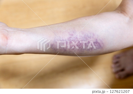 右腕の打撲の青あざ 右腕の打撲の青あざ 127621207