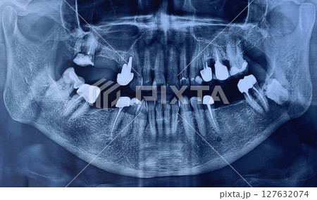 Close-up of image panoramic x-ray of teeth and jaw human Close-up of image panoramic x-ray of teeth and jaw human 127632074