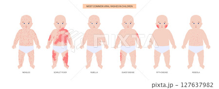The most common viral rashes 127637982