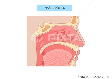 Nasal Polyps poster 127637989