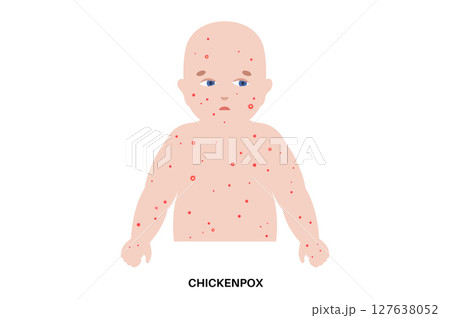 Varicella medical poster 127638052