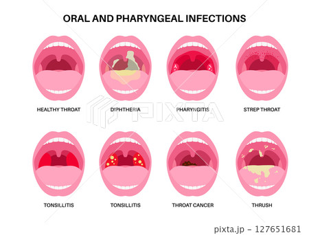 Oropharyngeal infections poster 127651681