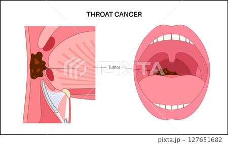 Throat cancer poster Throat cancer poster 127651682