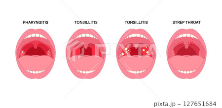 Pharyngotonsillitis oral disease 127651684