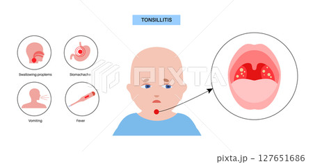 Tonsillitis Oral Desease 127651686