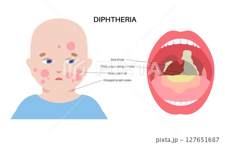 Diphtheria oral disease 127651687