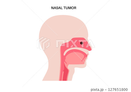 Nasal cancer poster 127651800