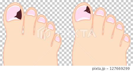 Nail internal bleeding progress set Nail internal bleeding progress set 127669299