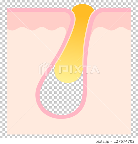 Cross-section of a pore clogged with keratin plugs Cross-section of a pore clogged with keratin plugs 127674702