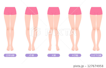 脚の歪み O脚矯正 骨盤のゆがみ 脚の歪み O脚矯正 骨盤のゆがみ 127674958