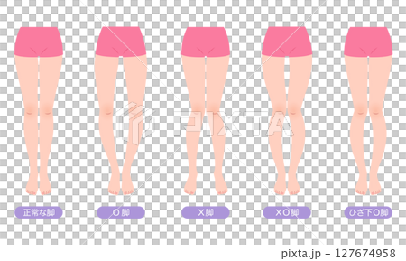 脚の歪み O脚矯正 骨盤のゆがみ 脚の歪み O脚矯正 骨盤のゆがみ 127674958