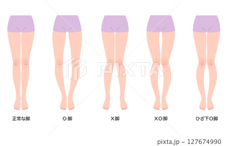 脚の歪み　O脚矯正　骨盤のゆがみ 127674990