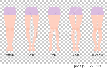 脚の歪み　O脚矯正　骨盤のゆがみ 127674990