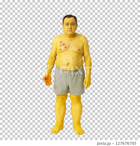 中年男子黃疸水腫醫學模式 | 皮膚病、肝病、醫學教育資料 127676785