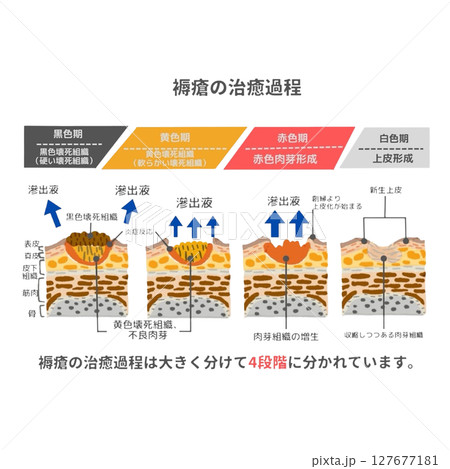 褥瘡の治癒過程を示した医療イラスト｜黒色期・黄色期・赤色期・白色期の変化 127677181