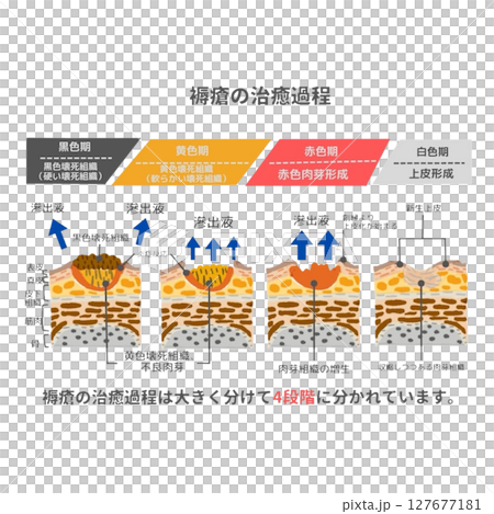 褥瘡の治癒過程を示した医療イラスト｜黒色期・黄色期・赤色期・白色期の変化 127677181