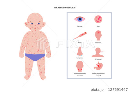 Measles or rubeola symptoms. 127691447