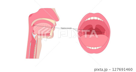 Palatine tonsils poster Palatine tonsils poster 127691460