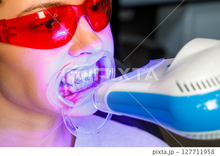 Dental whitening procedure with blue light on patient wearing red protective glasses 127711958