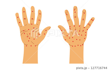 Chinese Acupuncture on Human Right Hand. Palm and Back of the Hand Vector Illustration. 127716744