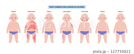 The most common viral rashes The most common viral rashes 127730821