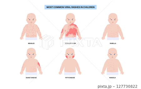 The most common viral rashes The most common viral rashes 127730822