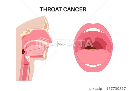 Throat cancer poster Throat cancer poster 127730837