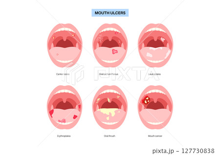 Types of mouth ulcer Types of mouth ulcer 127730838