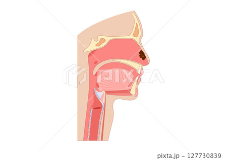 Nasal cancer poster 127730839