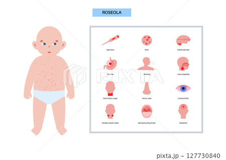 Roseola or exanthem subitum 127730840