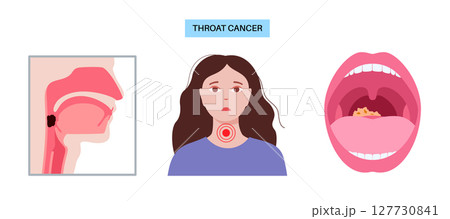 Throat cancer poster 127730841