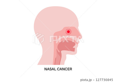 Nasal cancer poster 127730845