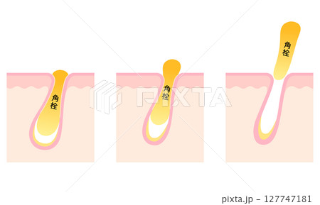 角栓の詰まった毛穴　断面図 127747181