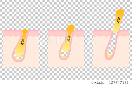 角栓の詰まった毛穴　断面図 127747181