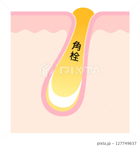 角栓の詰まった毛穴 断面図 角栓の詰まった毛穴 断面図 127749637