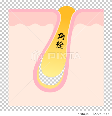 角栓の詰まった毛穴 断面図 角栓の詰まった毛穴 断面図 127749637
