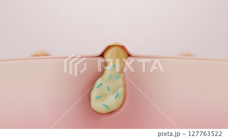 炎症で化膿したニキビと毛穴の断面図 肌トラブルの原因とアクネ菌CG 127763522
