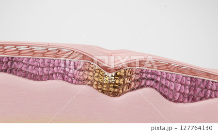 たるみとしわの原因となる皮膚構造の断面図 コラーゲンの減少イメージ たるみとしわの原因となる皮膚構造の断面図 コラーゲンの減少イメージ 127764130