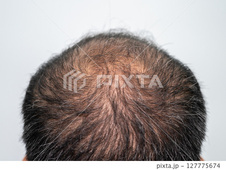 Close up of bald spot of Asian men's head with thin hair and grey hair appear. Close up of bald spot of Asian men's head with thin hair and grey hair appear. 127775674