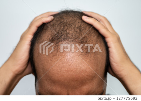 Asian man touching his head and having stress becaused of baldness problem. 127775692