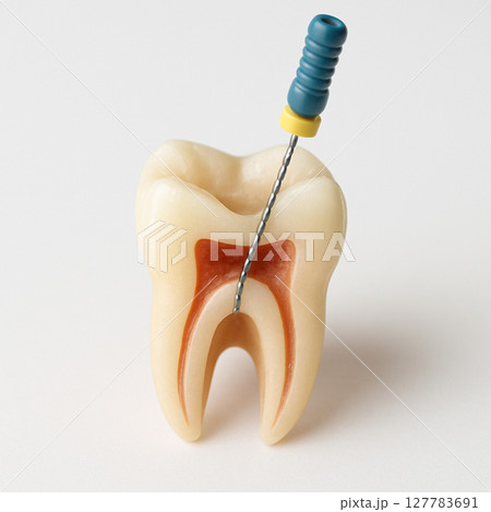 歯の根管治療 神経治療 127783691