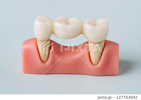 ブリッジ 入れ歯  義歯 治療 127783692