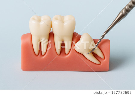 親知らずを抜歯する様子 127783695