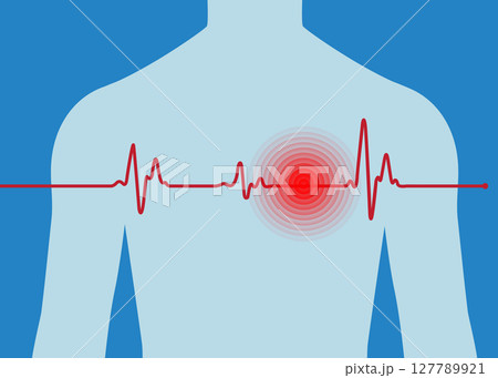 Man with heart attack with ECG graph against blue background. 127789921