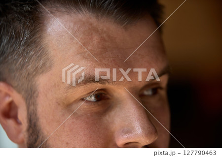 Inclusive beauty. Man with visible skin features, birthmark, looks calmly away from camera. 127790463