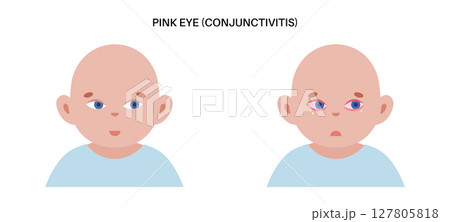 Conjunctivitis medical poster 127805818