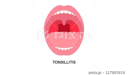 Tonsillitis Oral Desease 127805819